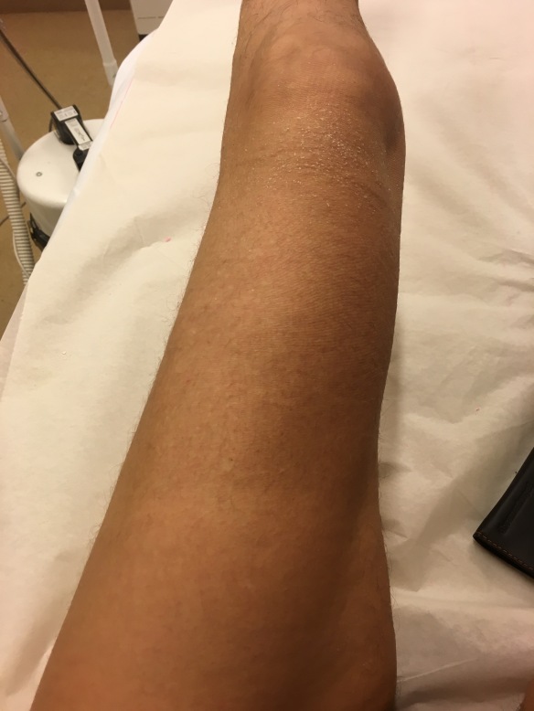 Bild på mitt ben efter 6 veckor i gips